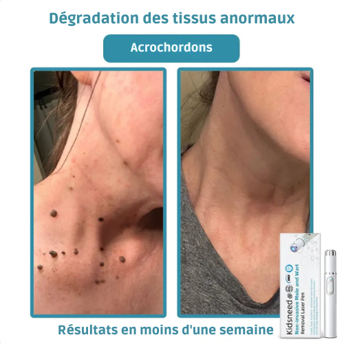 Stylo Laser non invasif Kidsneed® | Éliminer grains de beauté, verrues et acrochordons